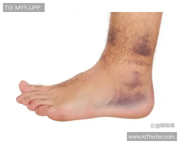 足球明星脚踝扭伤后的紧急处理与恢复技巧全解析